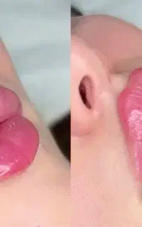 ژل لب فیلر فول فیس بوتاکس هایفوتراپی بلفارو