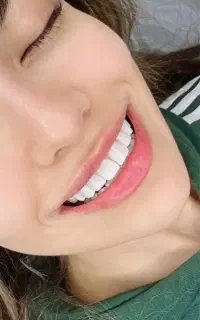 دندانپزشک ایمپلنت عصبکشی کامپوزیت در تبریز