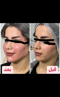 آموزش فوق تخصصی ژل وبوتاکس