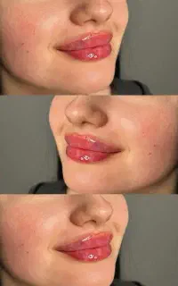 آموزش فیلر و بوتاکس و مزوژل