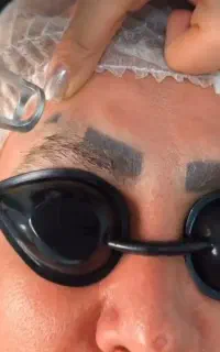 ریموو تخصصی تاتو صورت و بدن با پیشرفته ترین لیزر