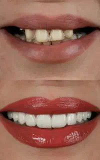 دندانپزشکی اقساطی ایمپلنت عصبکشی روکش لمینت و...