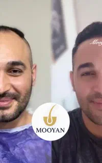کاشت مو‌۲۲ کاشت ابرو ۱۵