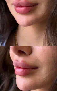 اموزش ژل و بوتاکس