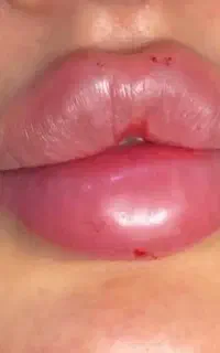 خدمات و تزریقات فیلر و ژل و بوتاکس و ساکشن غبغب