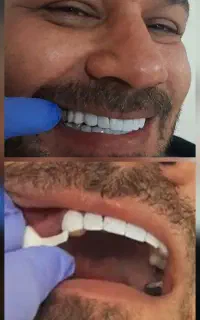 دندان برلیان