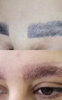 ریموو تک جلسه ای  رایگان