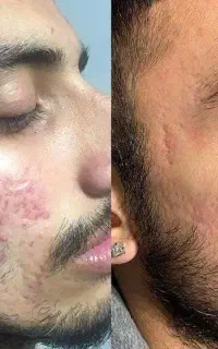 زیبایی صورت 30 روزه