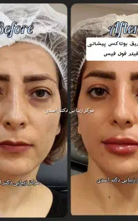 کلینیک زیبایی برای جوانسازی بوتاکس فیلر هایفو لیزر