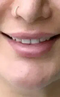 پیرسینگ.چال لپ.میکرودرمال