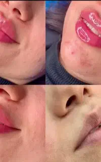 ژل و بوتاکس باکمترین قیمت در مطب زیبایی شفاطب