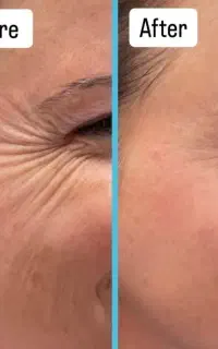 تمدید جشنواره بوتاکس و فیلر و جوان سازی