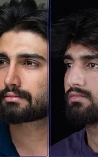 جراحی بینی با قیمت پارسال + اقساط + مشاور رایگان