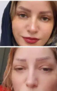 بلفاروپلاستی،لیفت شقیقه،دایرکت ابرو.