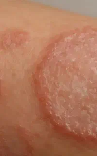 پماد گیاهی زگیل و قارچ پوستی