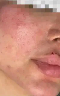ژل بوتاکس فیشال آرایش دایم