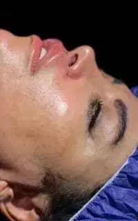بلفاروپلاستی چشم بالاپایین،پره بینی،ساکشن غبغب