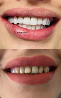 شرایط ویژه کامپوزیت دندان در تهران