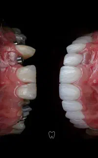 ایمپلنت و زیبایی دندانپزشکی