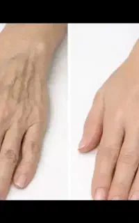 تزریق فیلر بادی با طراحی اختصاصی و فرم دهی عالی