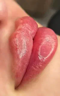 تزریق فیلر و بوتاکس توسط پزشک
