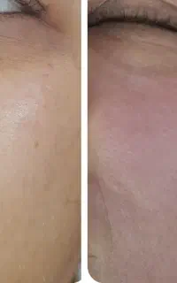 پاکسازی تخصصی مزونیدلینگ مزوایت با بهترین مواد