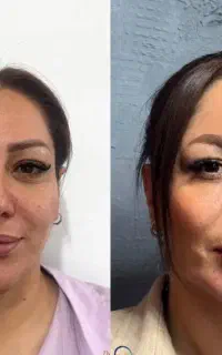 فیلر فول فیس سویئسی فرانسوی کره ای پکیجی اقساطی