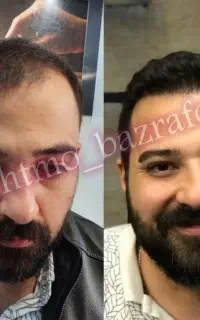 کاشت مو تکنسین شیرازی در تبریز