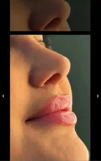 بوتاکس وپی ار پی و ژل
