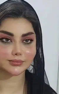 تزریق ژل وبوتاکس وجراعی بینی /پلک/لیفت صورت وغیره