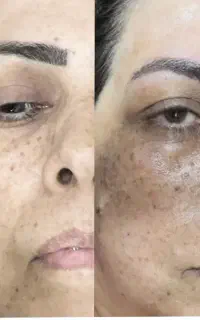 ۵۰٪ تخفیف درمان تخصصی پوست ولک وجوش و فیلر