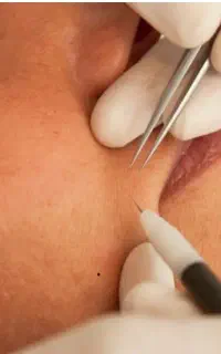 حذف موهای زاید سفید، خال و زگیل و کک ومک