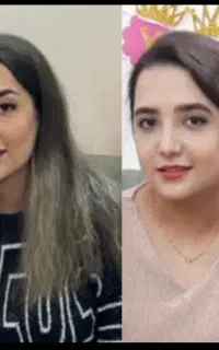 ژل و فیلرلب گونه زاویه فک کانتور نخ لیفت بوتاکس