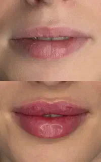 خدمات زیبایی ،فیلر، ژل،بوتاکس توسط پزشک با تجربه