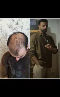 کاشت مو دائمی با تراکم بالا