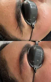 لیزرتخصصی ریموو تتو ابرو و تتوبدن رفع لک و جای جوش