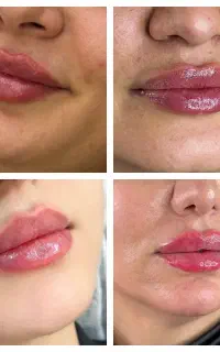 تزریق فیلر و بوتاکس توسط پزشک مجرب