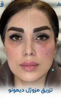 تخفیف تزریق فیلرلب،بادی،مزو،بوتاکس، نخ توسط پزشک