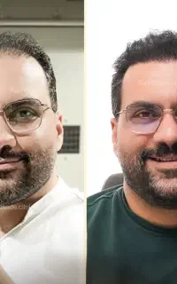 کاشت با ۱۲ میلیون تخفیف