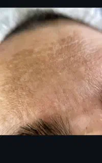 تخفیف درمان تخصصی پوست لک‌ سرسیاه منافذبازجوش اسکا
