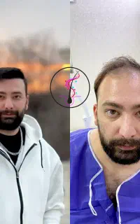 کاشت مو تضمین رشد و شرایط اقساطی