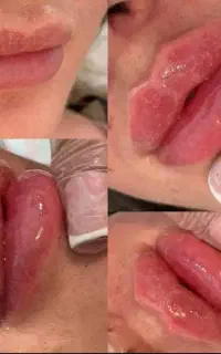جشنواره تزریق ژل و بوتاکس مشاوره رایگان