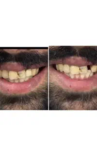 دندان مصنوعی (دندانسازی اقتصادی)