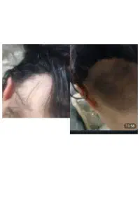 رویش مجدد مو
