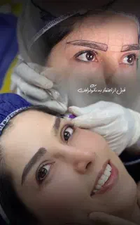 نانو گرافت کاشت دائمی ابرو - شرایط اقساط