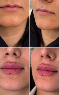 تزریق فیلر بوتاکس کانتور صورت