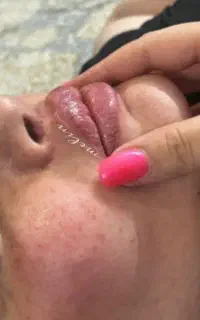 ژل و بوتاکس