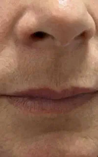 کاشت ابرو .لیفت ابرو .لیفت شقیقه .بوتاکس و فیلر
