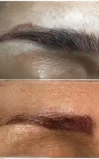 ریموو تتو صورت