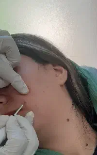 مزونیدلینگ،‌رفع تیرگی نواحی حساس،ریموو تتو،بوتاکس